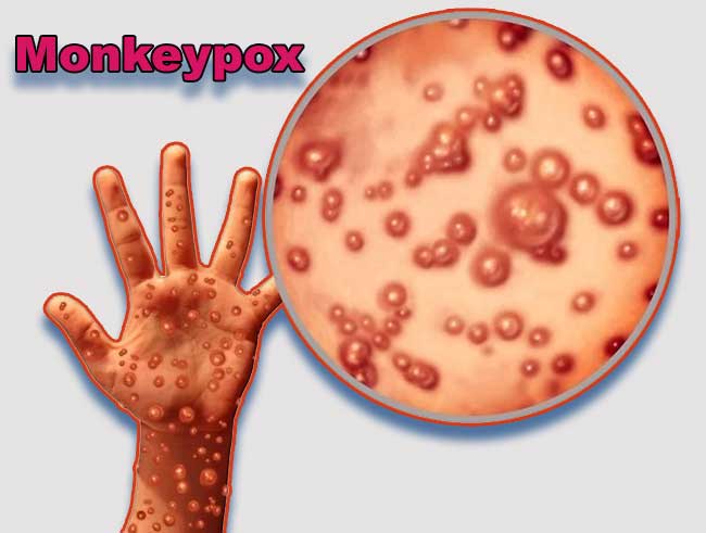 Monkeypox